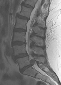 Cauda equina syndrome. Spinal Surgeon in Wirral.