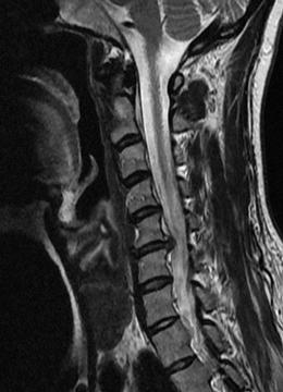 Cervical disc herniation. Spinal Surgeon in Liverpool.