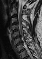 Cervical spondylotic myelopathy. Spinal Surgeon in Liverpool.