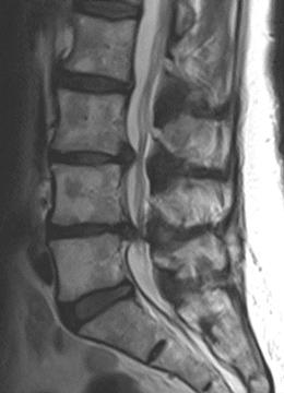 Lumbar spinal stenosis. Spinal Surgeon in Wirral.