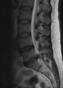 Lumbar disc herniation. Slipped disc. Spinal Surgeon in Wirral.