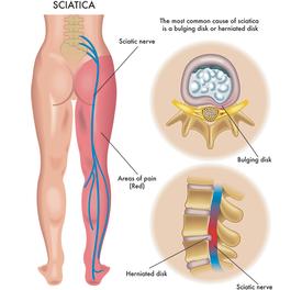 Sciatica pain. Spinal Surgeon in Liverpool and Wirral.