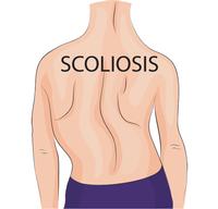 Scoliosis. Spinal Surgeon in Liverpool and Wirral.