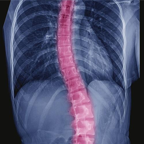 Scoliosis. Spinal Surgeon in Liverpool and Wirral.